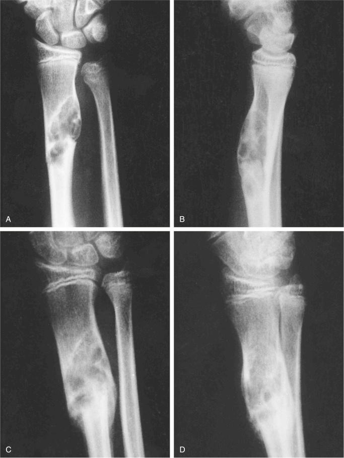 FIGURE 9-7, Nonossifying fibroma: radiographic features.