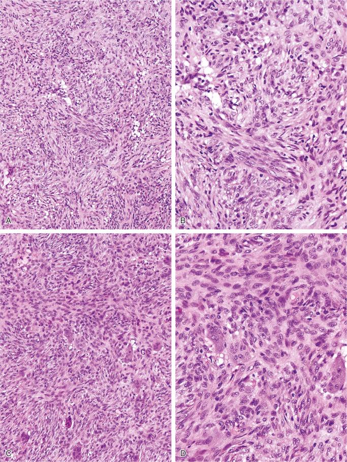 FIGURE 9-9, Nonossifying fibroma: microscopic features.