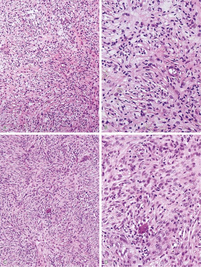 FIGURE 9-10, Nonossifying fibroma: microscopic features.