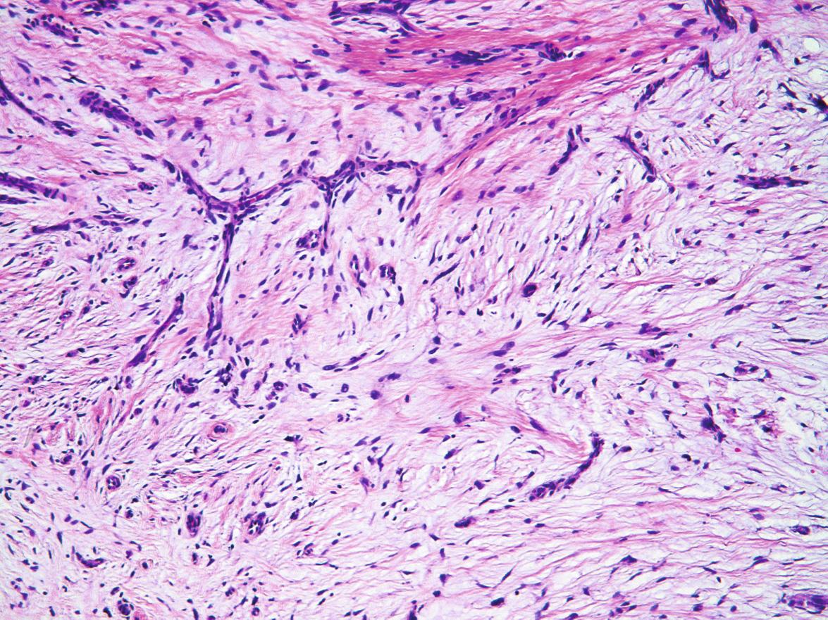 Fig. 116.11, Superficial acral fibromyxoma.