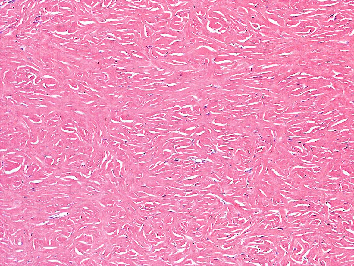 Fig. 116.12, Sclerotic fibroma.