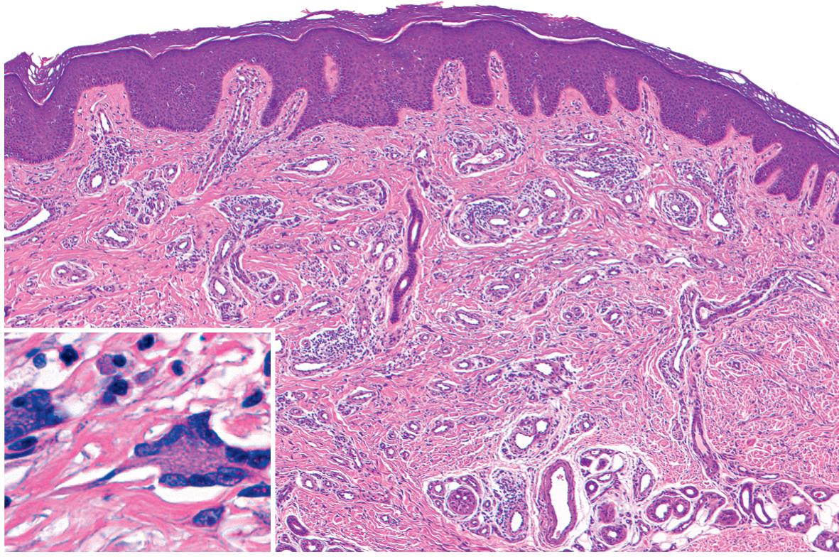 Fig. 116.15, Multinucleate cell angiohistiocytoma.