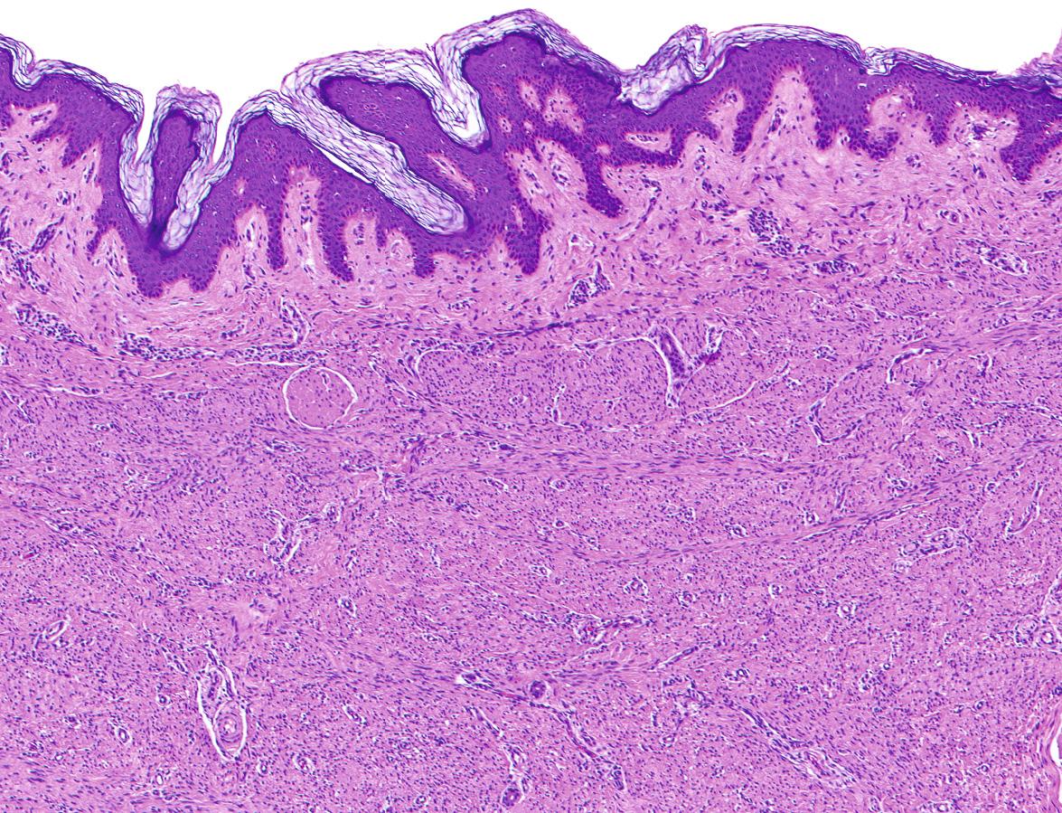 Fig. 116.16, Dermatomyofibroma.