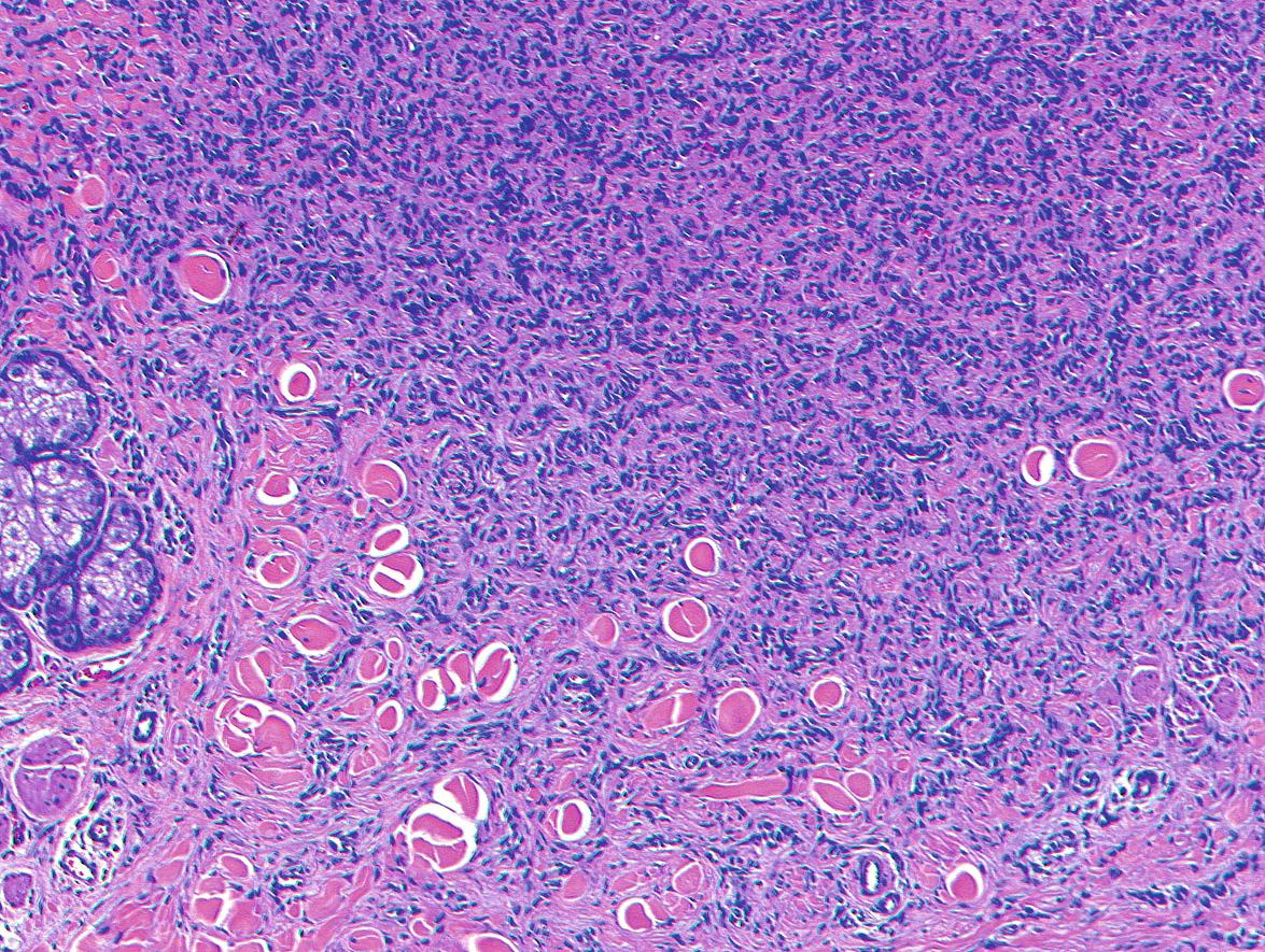 Fig. 116.7, Dermatofibroma.