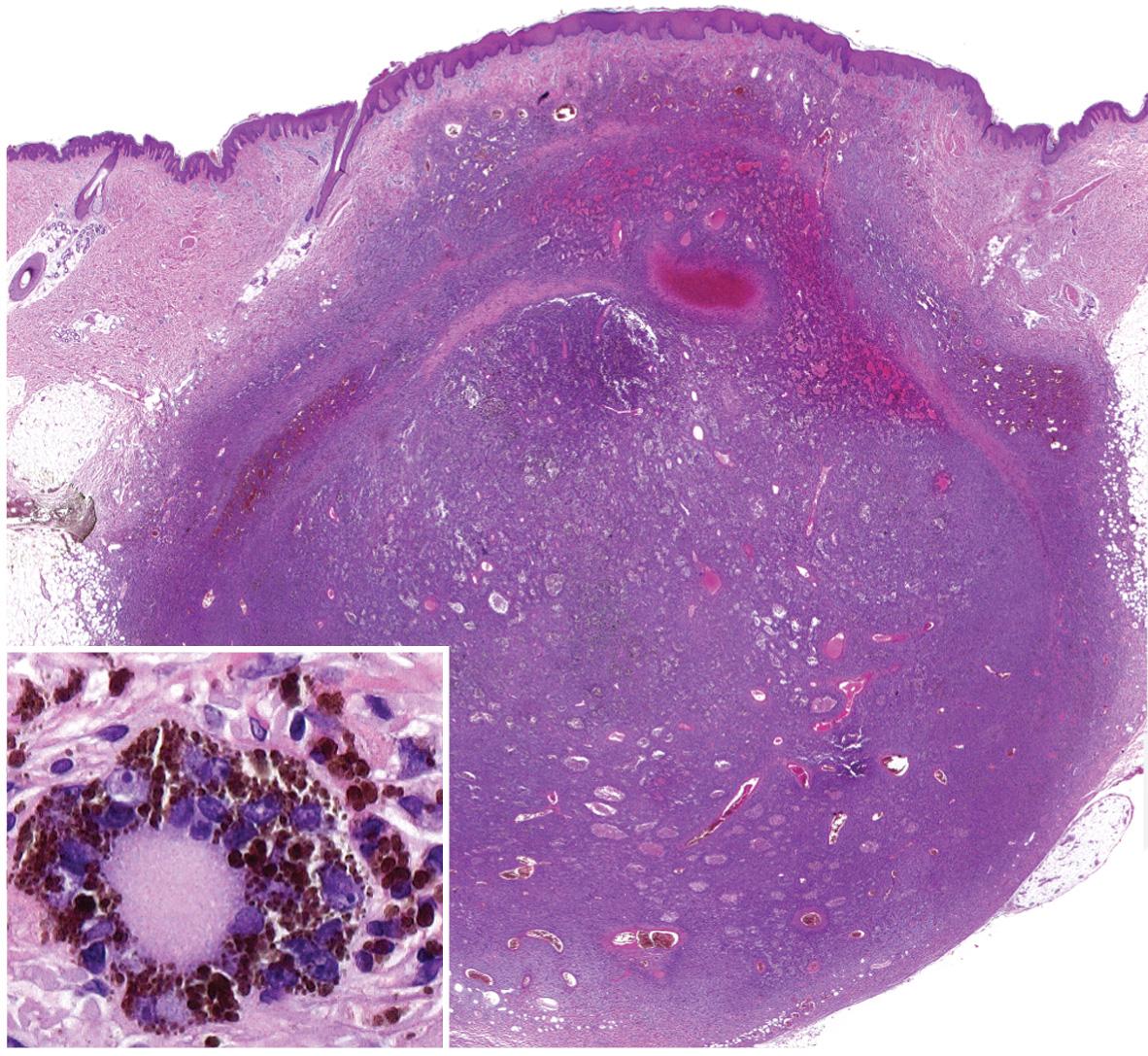 Fig. 116.8, “Aneurysmal” dermatofibroma.