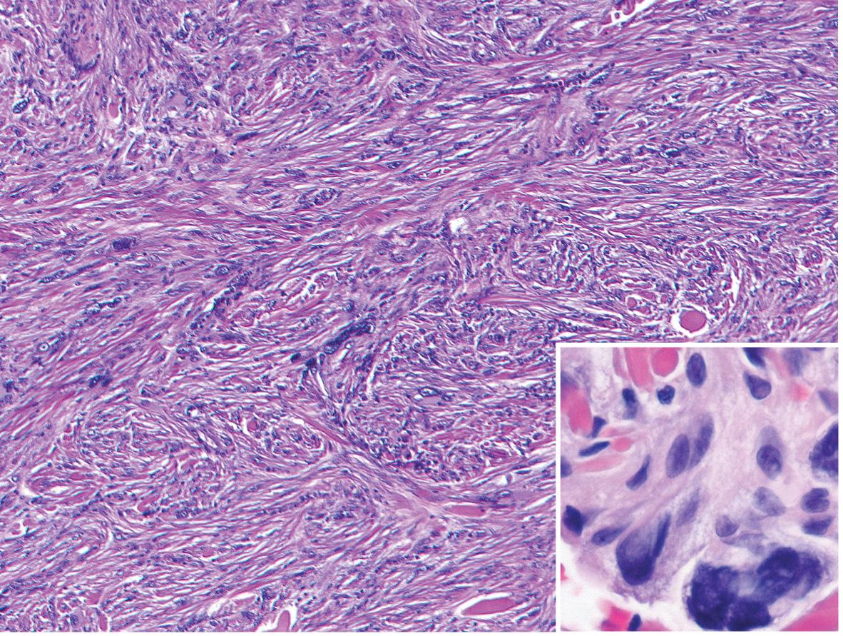 Fig. 116.9, Dermatofibroma with atypical cells (“monster” cells).