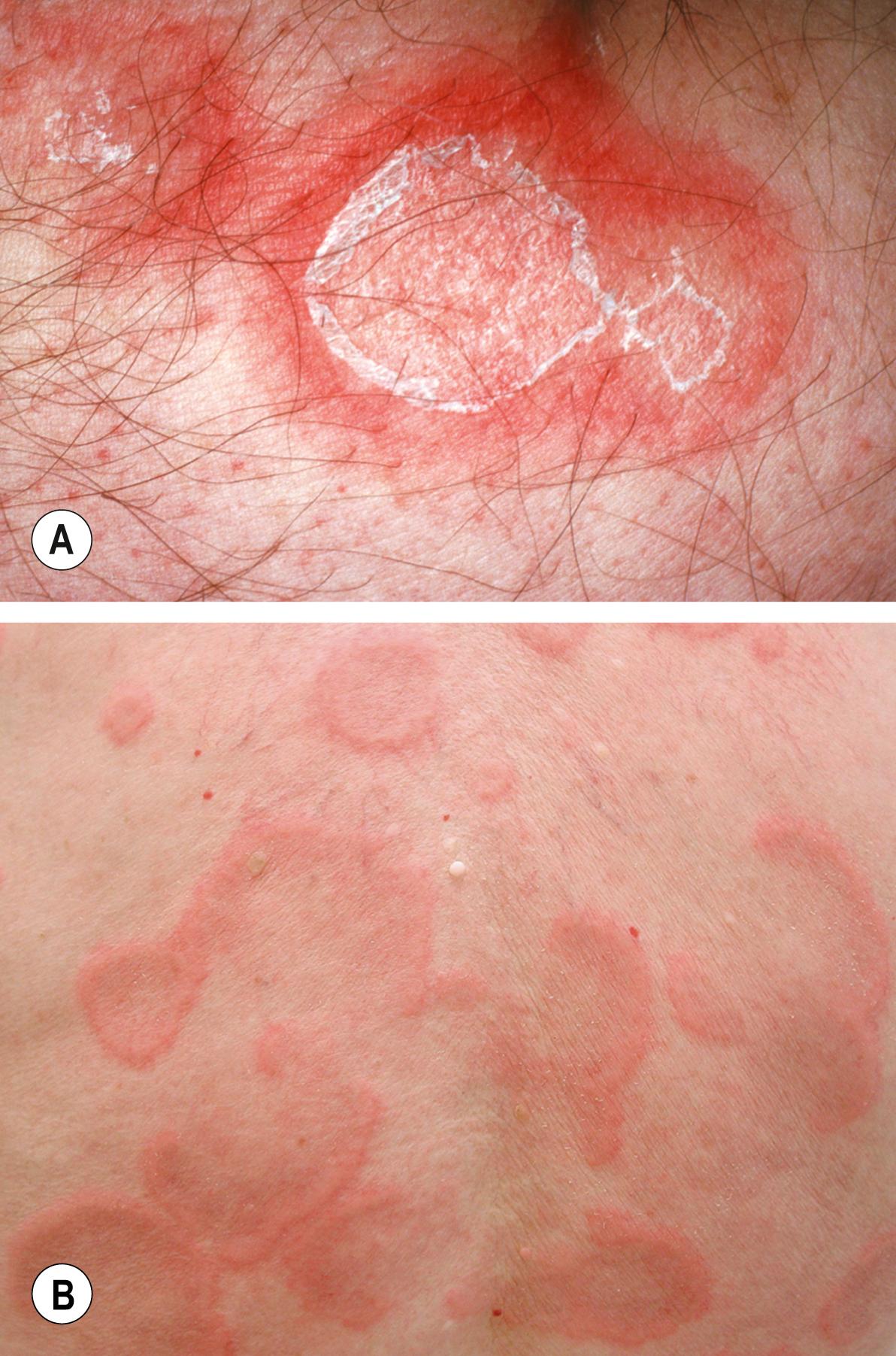 Fig. 15.1, Erythema annulare centrifugum.