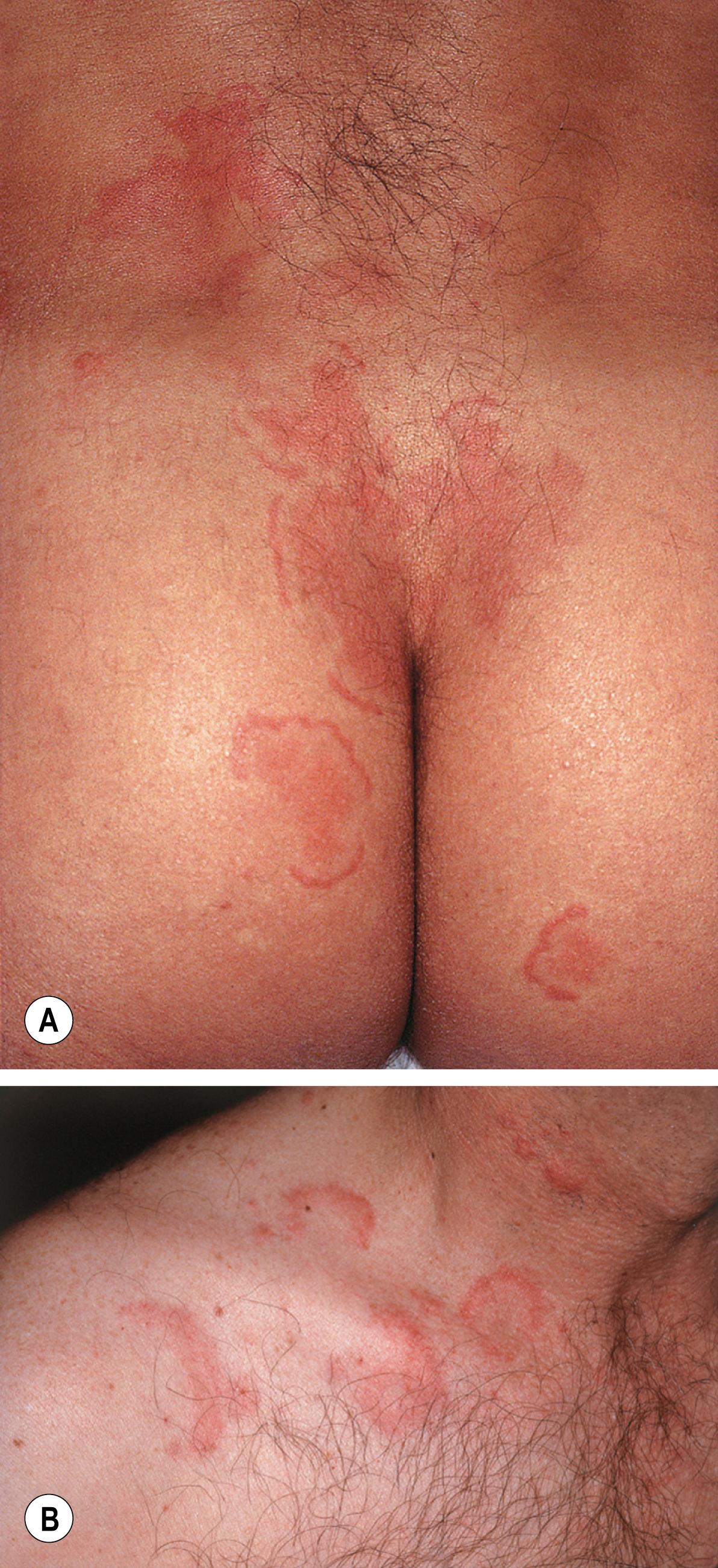 Fig. 15.2, A comparison of erythema annulare centrifugum and urticaria.