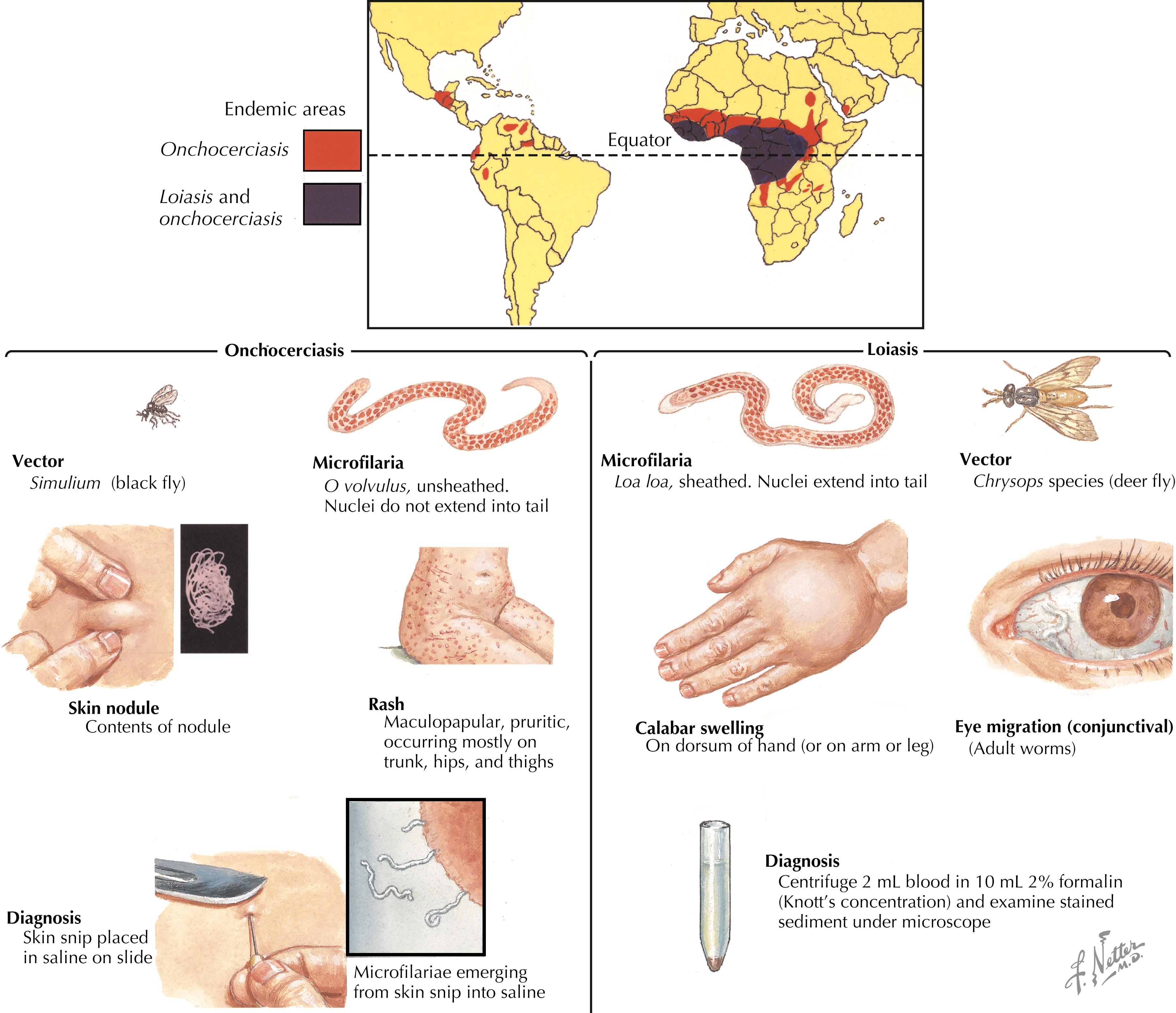 Fig. 84.2, Filariasis: onchocerciasis and loiasis.