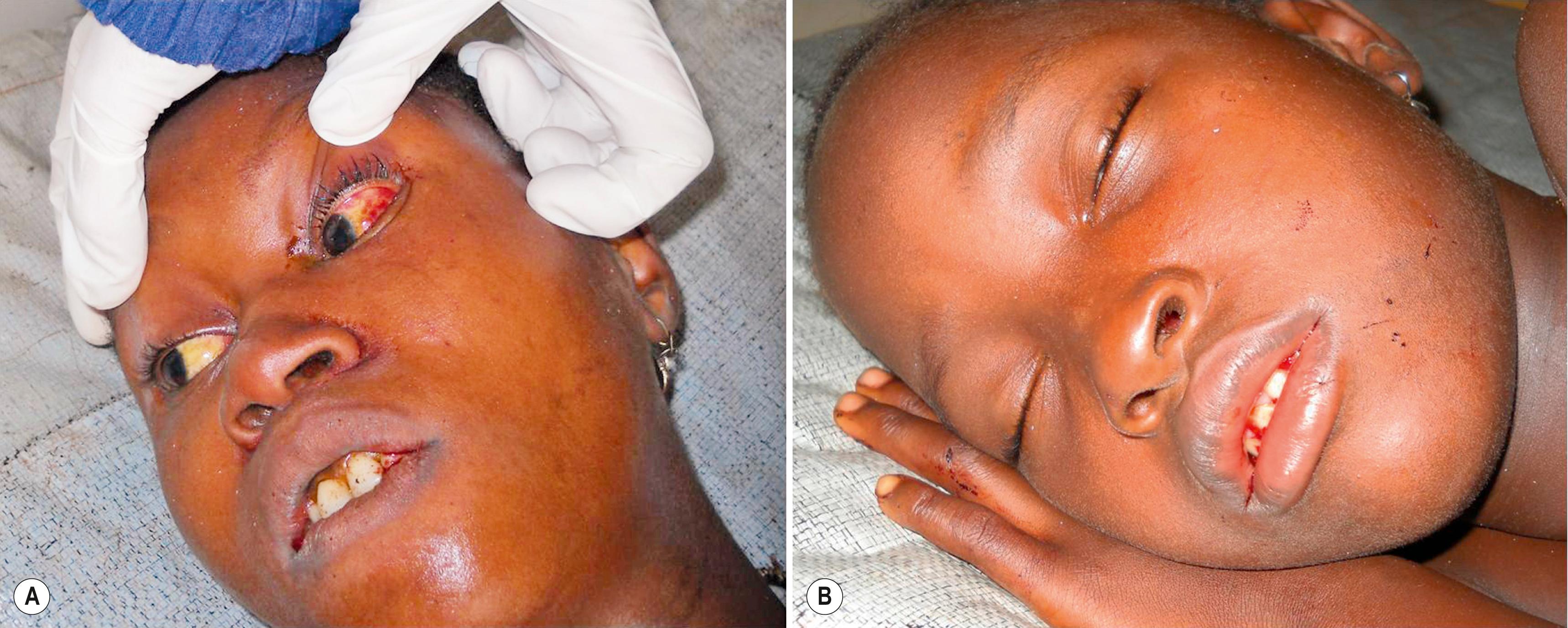 FIGURE 230.1, Subconjunctival hemorrhage, oral bleeding (A), and facial swelling (B) in patients with Lassa fever.