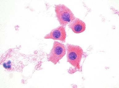 Fig. 4.4, Oncocytoma.