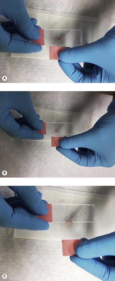 Figure 20-2, Smearing technique composite: the “spreader” slide is gently lowered onto the sample, until the “spreader” slide and the sample come into contact (top). The sample will spread due to capillary action between the two slides (middle). At this moment, the “spreader” slide is pulled away from the frosted end on the slide in a single, swift motion (bottom).