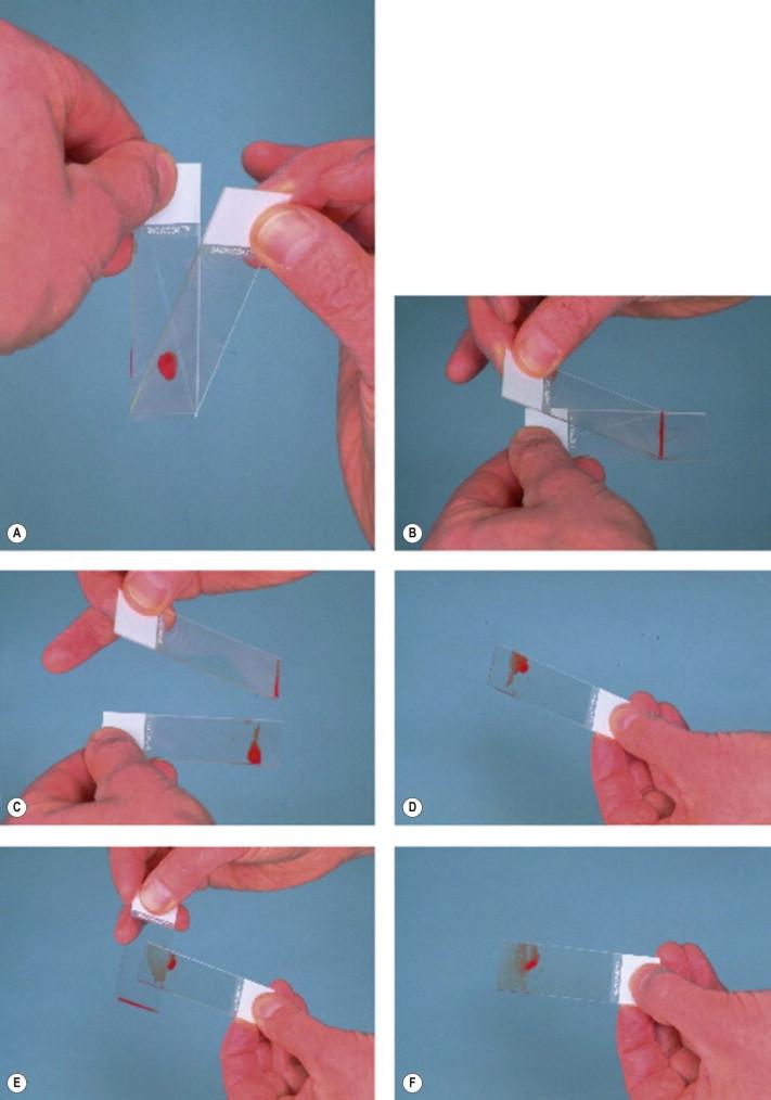 Figure 20-4, A drop of biopsy material is placed toward one end of a glass slide approximately 5 mm in diameter. The slide with the drop of biopsy material is held in the left hand. Take a second slide with the right hand, bringing the edge of that slide up to the drop. The drop of biopsy begins to spread along the edge of the slide in the right hand (A). As it does, begin to push the edge of the slide in the right hand toward the end farthest from the drop, but only about halfway down the slide in the left hand. This procedure is similar to making a blood smear (B,C). When the halfway point of the slide in the left hand is reached, lift the spreader slide (in the right hand) straight up off the slide in the left hand. Immediately tilt the smear slide that is in the left hand away from the leading edge of that smear. Note that the blood runs back toward the point where the drop of sample was placed originally (D). Next, begin smear preparation with the lateral clean edge of the slide in the right hand (spreader slide), but only from the leading edge of the slide in the left hand (E). Tissue particles that may be present will be concentrated in that part of the smear that was prepared from the leading edge of the slide in the left hand (F).