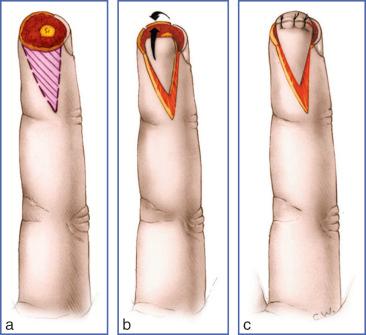 Fig. 9.12, Kutler Flap.