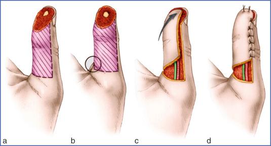 Fig. 9.14, Hueston Flap (Right Thumb).