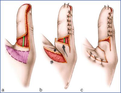 Fig. 9.15, Argamaso Technique (Left Thumb).