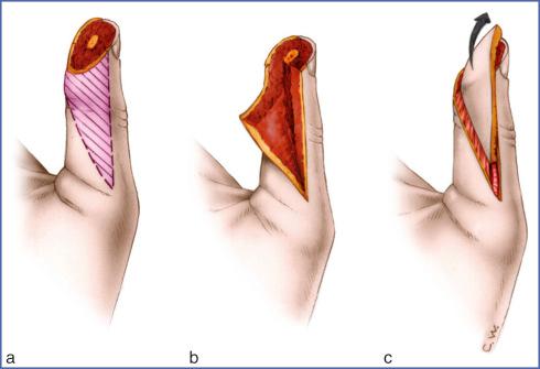 Fig. 9.16, Venkataswami and Subramanian Flap.