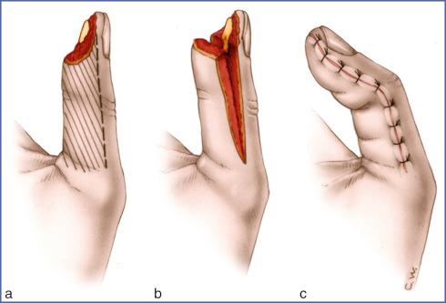 Fig. 9.17, Moberg Flap.