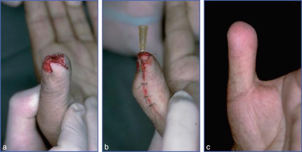 Fig. 9.18, Moberg Flap.