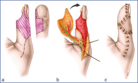 Fig. 9.23, Joshi and Pho Flap.