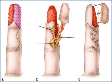 Fig. 9.24, Pulp Exchange Plasty.