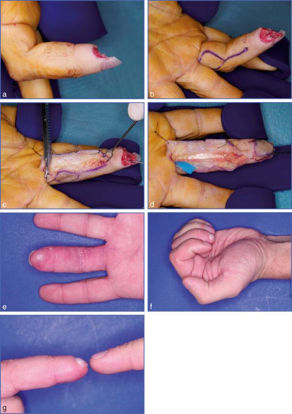 Fig. 9.28, Reverse Vascular Island Flap in Its Nonresensitized Variant.