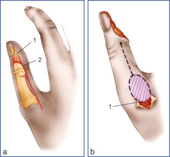 Fig. 9.29, Dorsoulnar Island Flap for Pulp Cover of Thumb.