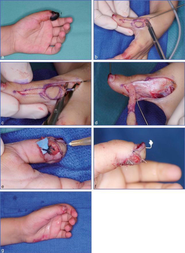 Fig. 9.30, Dorsoulnar Island Flap to Cover a Thumb Pulp Defect.