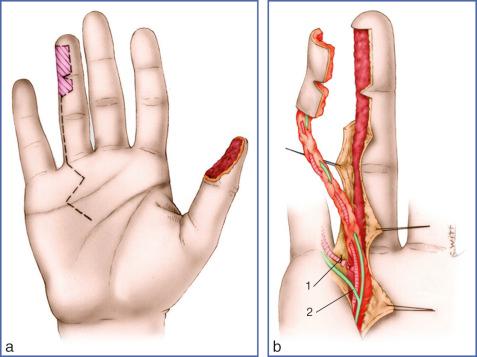 Fig. 9.31, Heterodigital Vascular Island Flap.