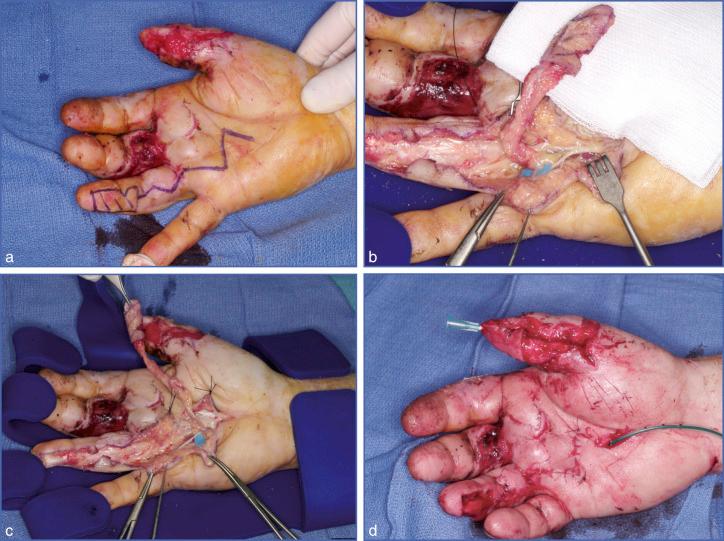 Fig. 9.32, Heterodigital Vascular Island Flap (Dr. F. Delerang's Case).