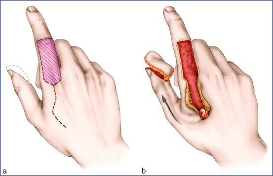 Fig. 9.33, Kite Flap for Thumb Pulp Defects.