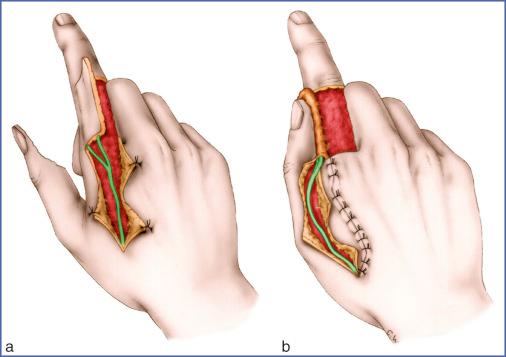 Fig. 9.34, Gaul Technique for Thumb Pulp Soft Tissue Defects.