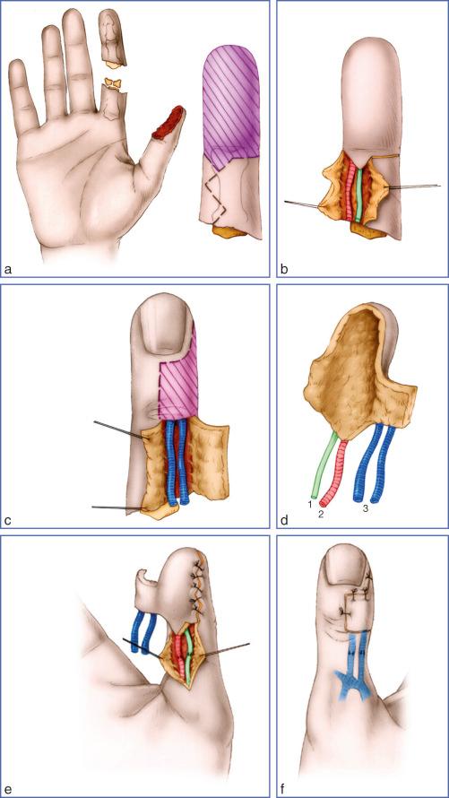 Fig. 9.35, Pulp Free Flap According to Finger Bank Principle.