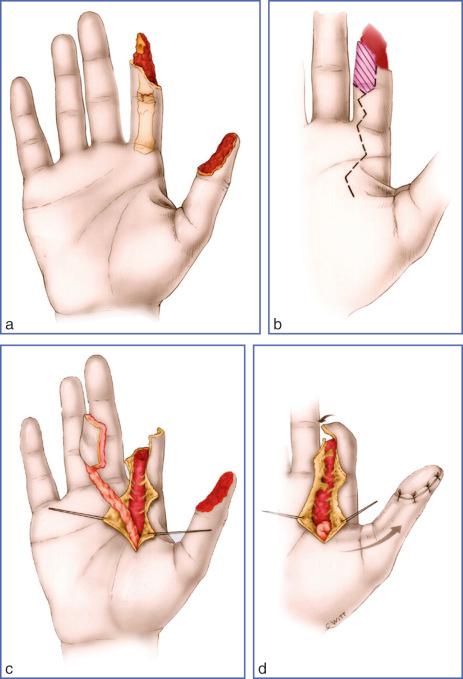 Fig. 9.36, Pulp Island Flap According to Finger Bank Principle.