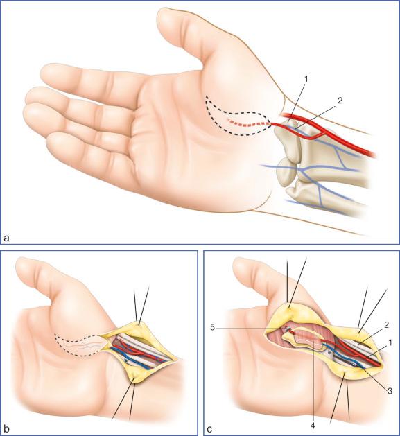 Fig. 9.37, Free Thenar Flap for Pulp Reconstruction.