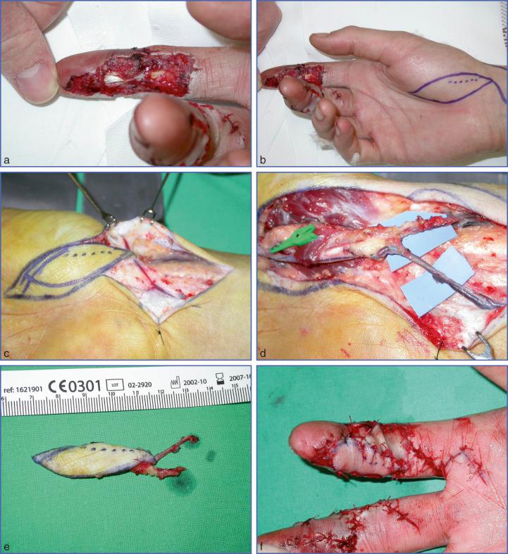 Fig. 9.38, Use of Free Thenar Flap for Coverage of Palmar Soft Tissue Defects of Index Finger.