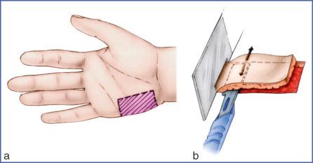 Fig. 9.42, Harvesting a Thick Split Skin Graft of Hypothenar Origin.