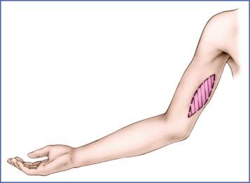 Fig. 9.43, Donor Site of Full-Thickness Skin Grafts