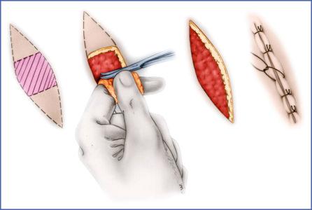 Fig. 9.44, Technique for Harvesting a Full-Thickness Skin Graft