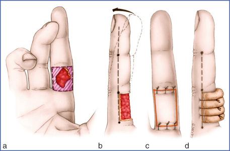 Fig. 9.45, Use of Full-Thickness Skin Graft for Middle Palmar Digital Segment.