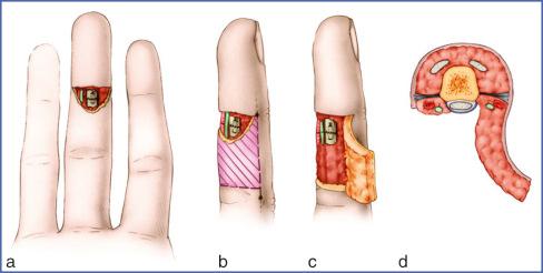 Fig. 9.46, Hueston Flap.