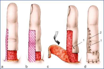 Fig. 9.48, Laterodigital Flap.