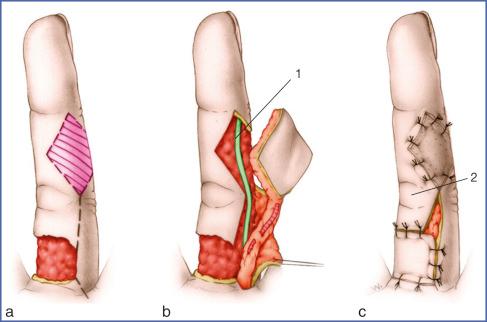 Fig. 9.49, Island Flap Based on Palmar Digital Artery.