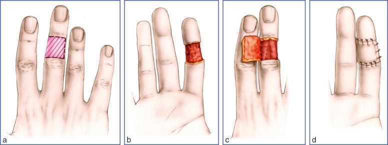 Fig. 9.50, Cross-Finger Flap for Palmar Coverage.