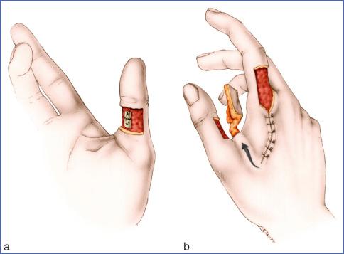 Fig. 9.52, Use of Kite Flap for Coverage of Middle Palmar Digital Segment of Thumb.