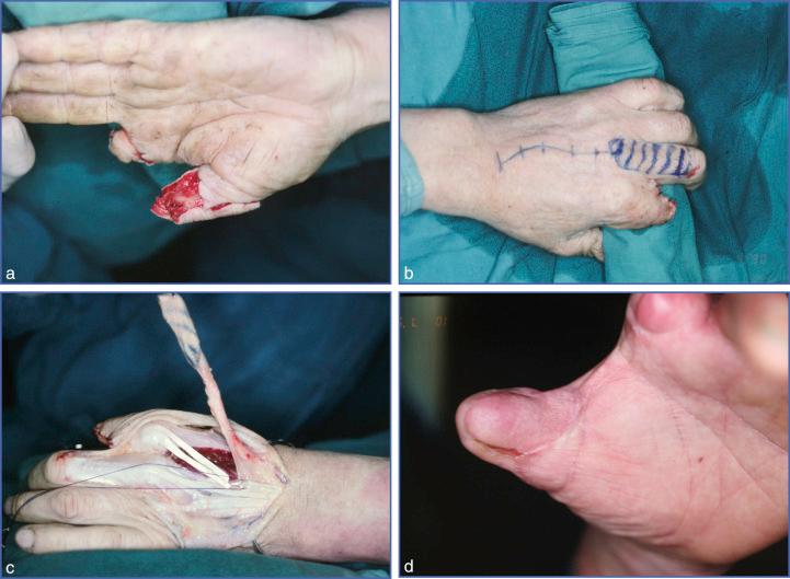 Fig. 9.53, Use of Dorsal Sensitive Island Flap Harvested from Second Intermetacarpal Space for P1 Coverage of Thumb.