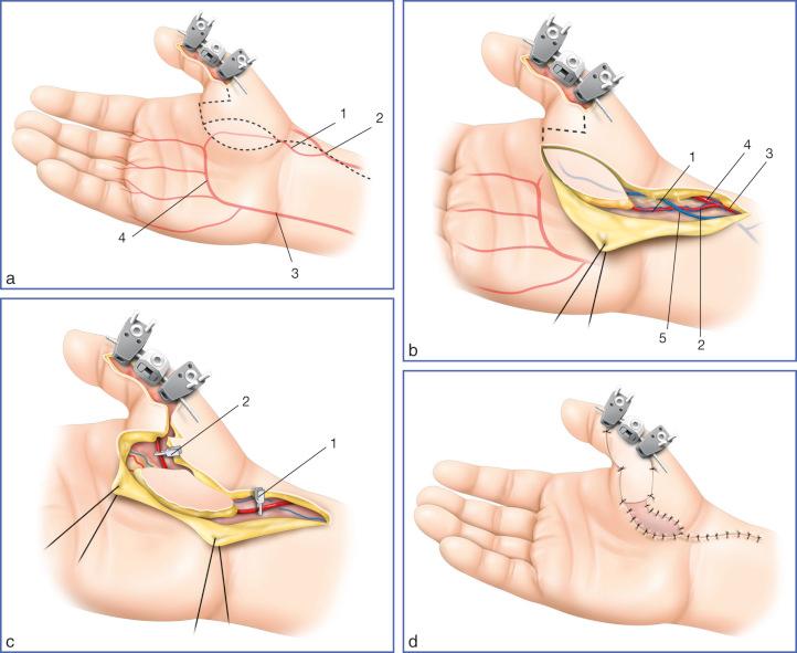 Fig. 9.54, Use of a Distally Based Thenar Flap to Cover the Middle Digital Segment.