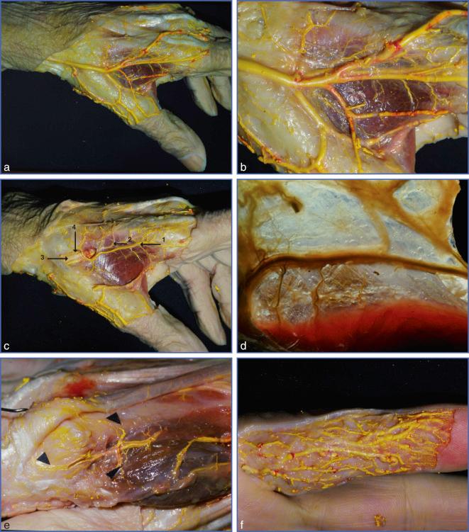 Fig. 9.59, Injection study of arterial and venous network of the hand and fingers.