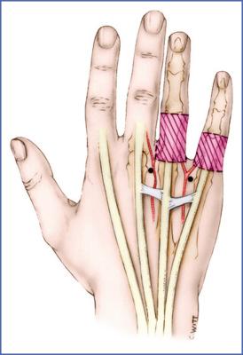 Fig. 9.61, Vascularization of the Dorsal Skin of the Fingers.