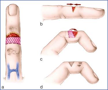 Fig. 9.63, Bipedicle Advancement, or Reverse-Flow Flap.